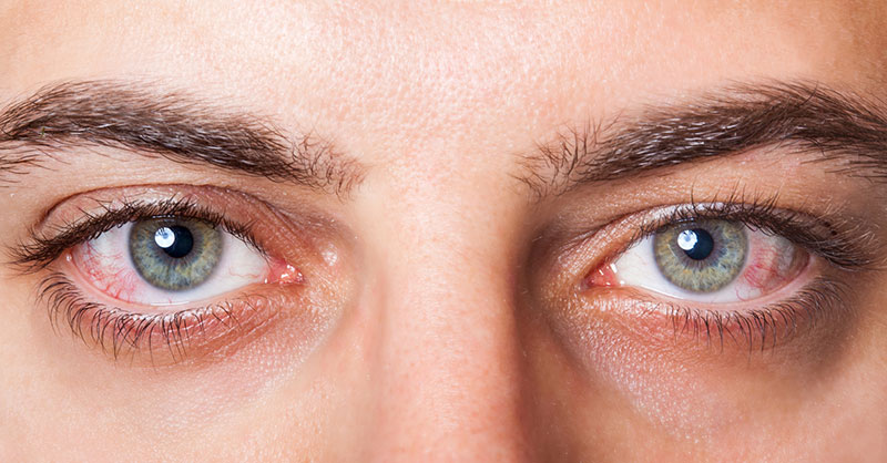 درمان خشکی چشم در طب سنتی