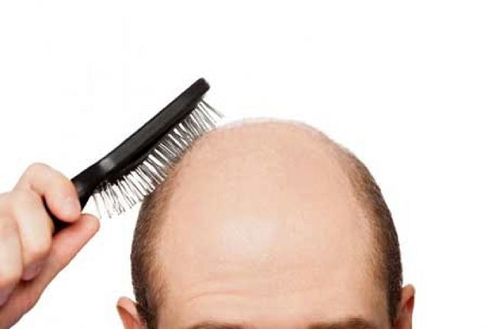درمان کچلی سر و تقویت مو و ابرو