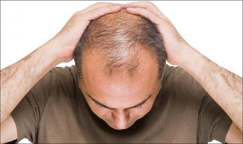 ریزش مو در اثر کم کاری کبد