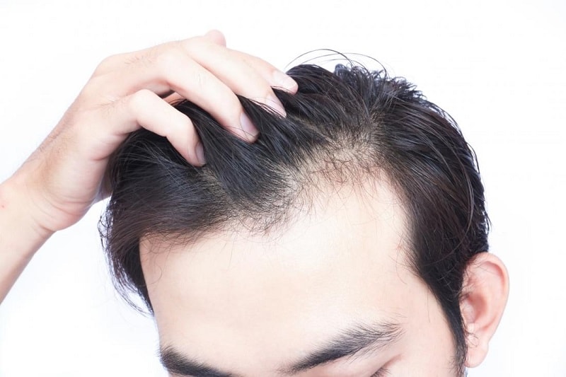 سایر علل ریزش مو
