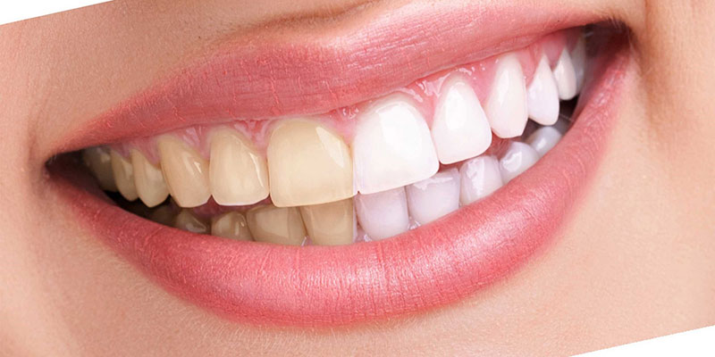 سفید کردن دندان ها-1