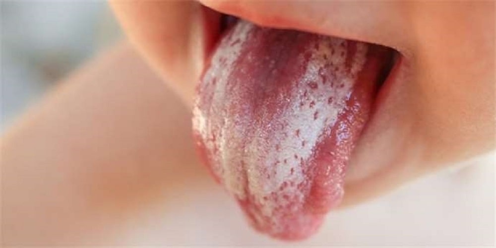 درمان برفک دهان با سرکه سیب