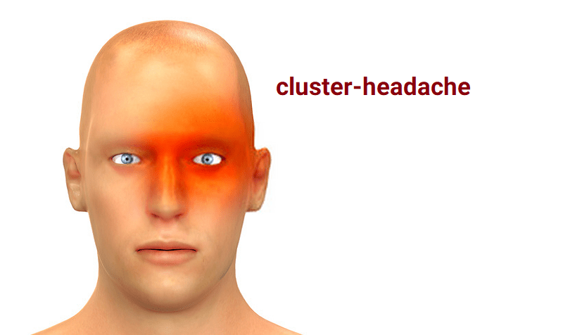 سردرد خوشه ای (Cluster headaches) 